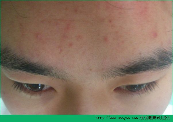 13岁脸上长痘痘怎么办？13岁脸上长斑怎么办？(1)