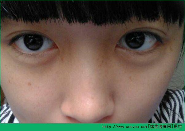 13岁脸上长痘痘怎么办？13岁脸上长斑怎么办？(3)