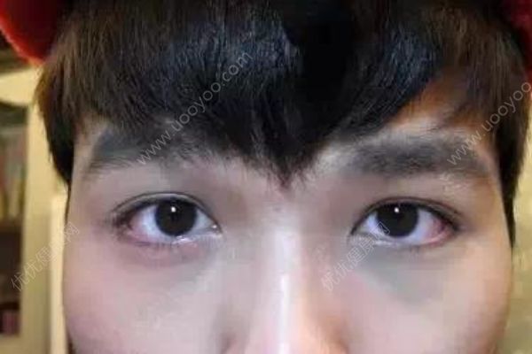 黑眼圈的原因不只是因为熬夜，肾虚黑眼圈怎么调理好？[
