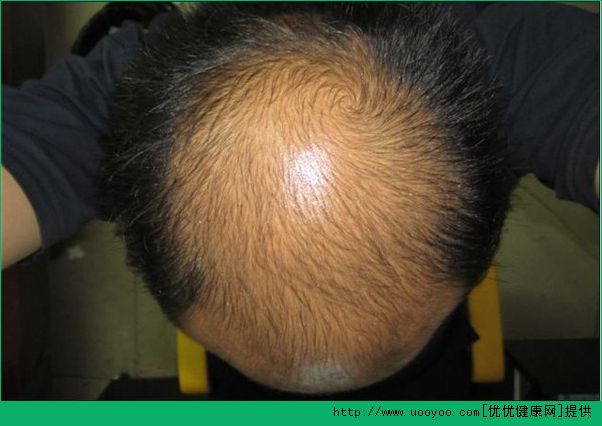 男人脱发的主要原因是什么？男人脱发怎么治疗？(5)