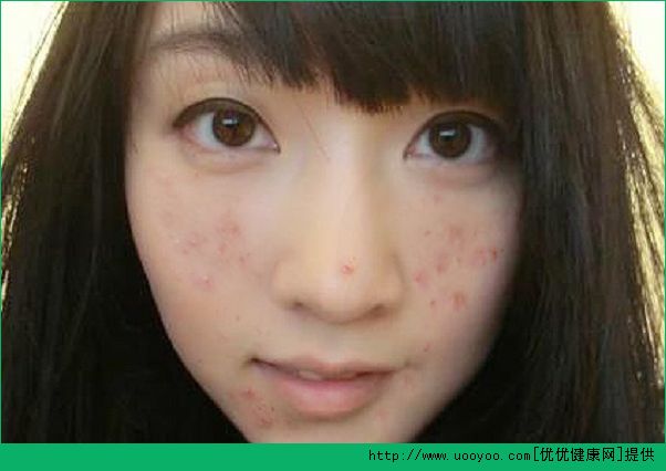 18岁脸上长了青春痘怎么办？青春痘怎么治疗？(2)