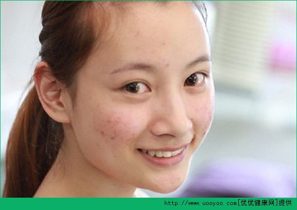 18岁脸上长了青春痘怎么办？青春痘怎么治疗？(3)