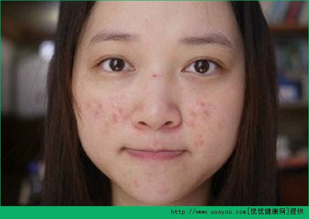 18岁脸上长了青春痘怎么办？青春痘怎么治疗？(4)