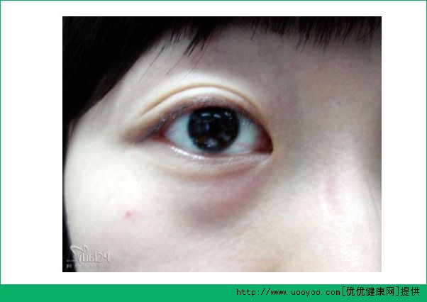 卧蚕和黑眼圈有什么区别？卧蚕和眼袋有什么区别？(2)