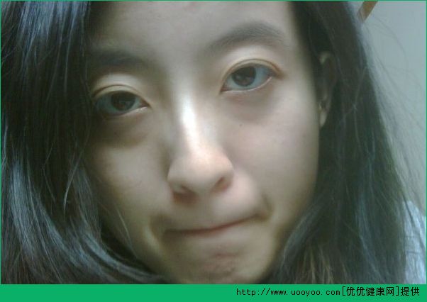 卧蚕和黑眼圈有什么区别？卧蚕和眼袋有什么区别？(3)