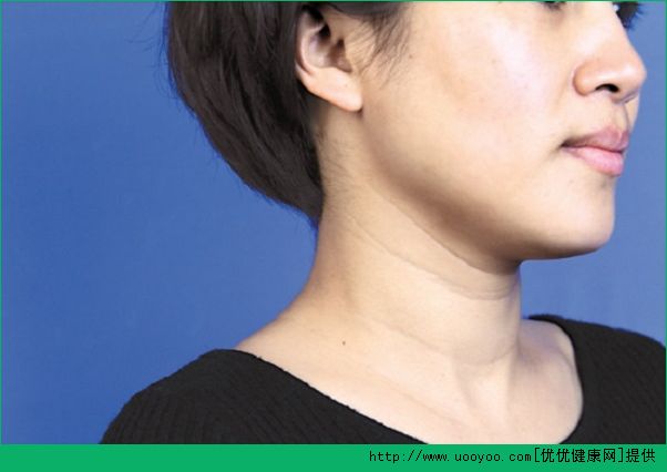 颈纹是怎么形成的？女人颈纹是怎么形成的？(3)