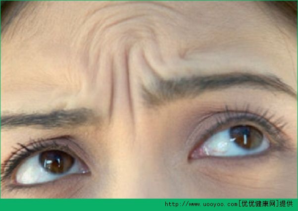 眉间纹是怎么形成的？眉间纹如何去除？(3)