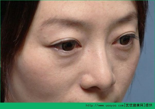 额头出油多是什么原因？额头总出油是什么原因？(5)