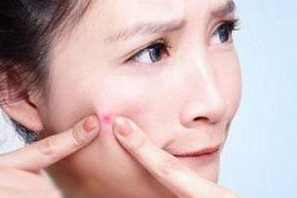 高中生脸上长痘怎么办？高中生如何快速祛痘？(1)