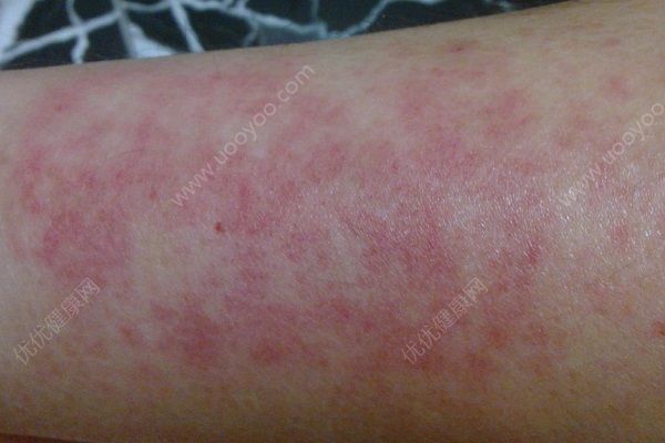 南瓜容易过敏吗？吃南瓜会过敏吗？[多图]