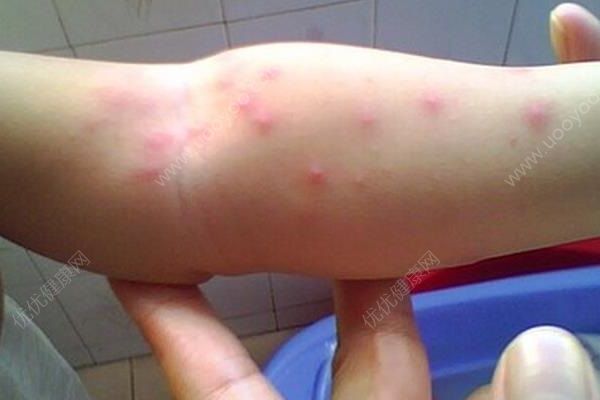 南瓜容易过敏吗？吃南瓜会过敏吗？(2)