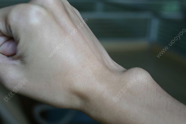 我手腕上长个包怎么回事？我手腕上长了个疙瘩(2)