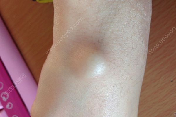 我手腕上长个包怎么回事？我手腕上长了个疙瘩(1)
