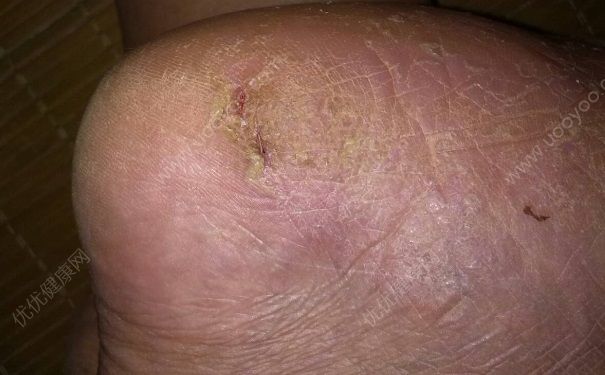 脚底裂开是什么原因？脚底裂开了口子怎么办？(5)