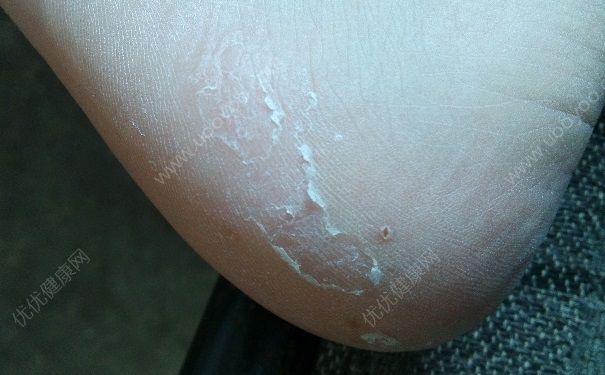 脚底裂开是什么原因？脚底裂开了口子怎么办？(4)