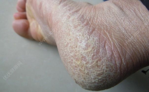 脚底裂开是什么原因？脚底裂开了口子怎么办？(2)