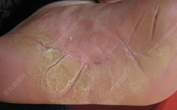 脚底裂开是什么原因？脚底裂开了口子怎么办？(3)