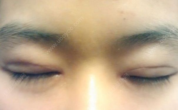 男生可以割双眼皮吗？男生可以做双眼皮手术吗？(4)