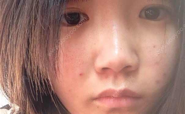 长青春痘怎么消除？青春痘怎么去除？(1)