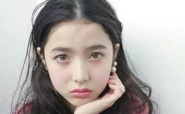初中女生可以点痣吗？点痣后要注意什么？(1)