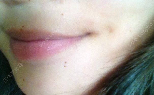 初中女生可以点痣吗？点痣后要注意什么？(2)