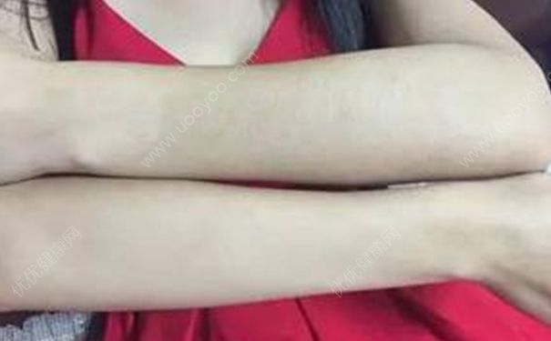 女生手臂汗毛多是怎么回事？女生手臂汗毛长怎么办？(3)