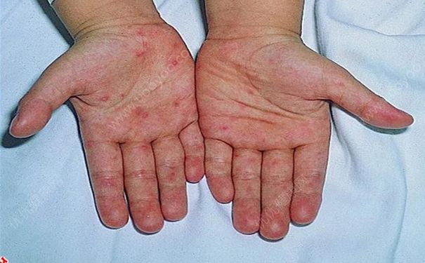 香港爆发手足口病 手足口病如何预防？[多图]