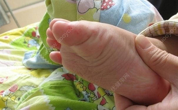 香港爆发手足口病 手足口病如何预防？(2)