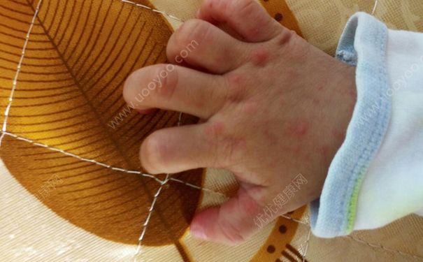 香港爆发手足口病 手足口病如何预防？(3)