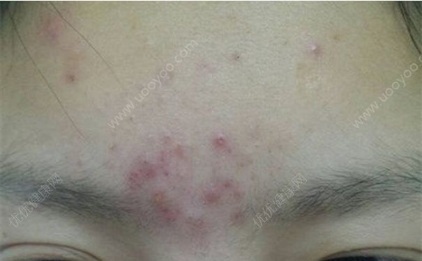 眉心长痘痘是什么原因？眉心长痘痘怎么办？(1)
