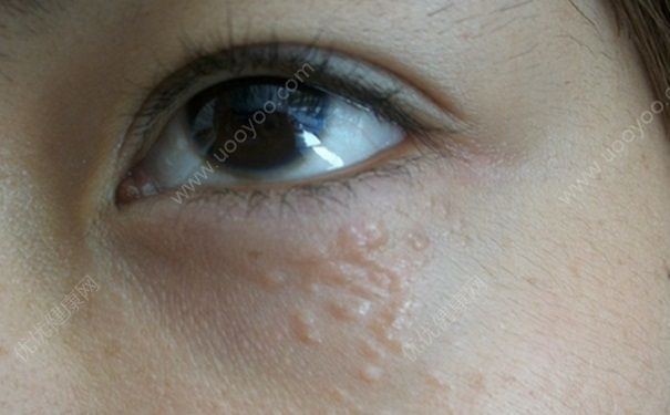 用眼霜会长脂肪粒吗？眼霜用了长脂肪粒怎么办？[多图]