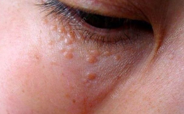 用眼霜会长脂肪粒吗？眼霜用了长脂肪粒怎么办？(2)