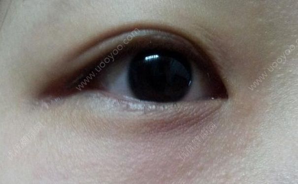 用眼霜会长脂肪粒吗？眼霜用了长脂肪粒怎么办？(3)