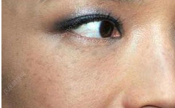 熬夜会长斑吗？熬夜对皮肤的危害[多图]