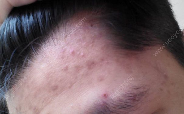 熬夜会长斑吗？熬夜对皮肤的危害(4)