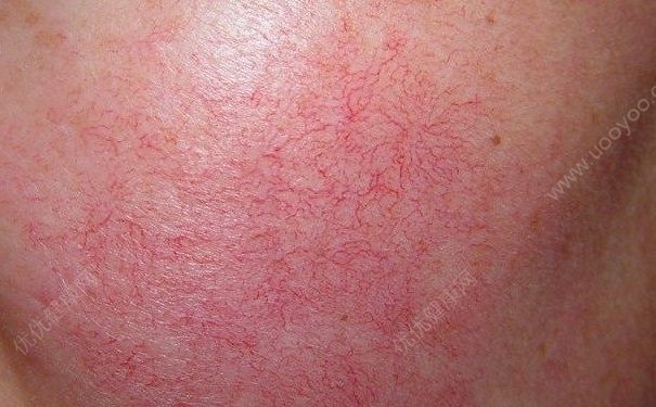 洗面奶洗脸后紧绷是什么？洗面奶洗脸后脸红红的？(4)