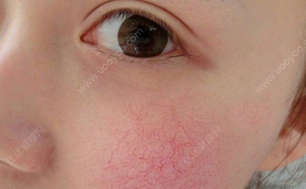 洗面奶洗脸后紧绷是什么？洗面奶洗脸后脸红红的？(3)