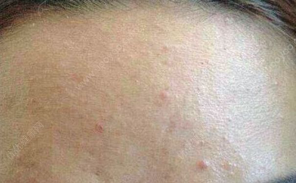 用洗面奶会长痘痘吗？洗面奶的使用步骤？(3)