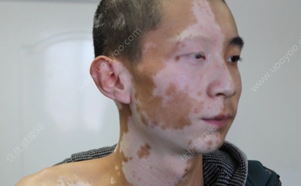 青少年患上白癜风怎么办？青少年患上白癜风的原因？[多