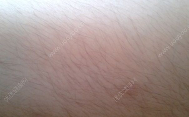 青少年可以用脱毛膏吗？青少年汗毛多怎么办？(2)