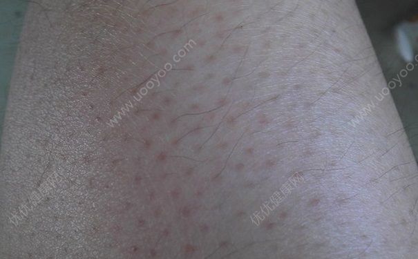 青少年可以用脱毛膏吗？青少年汗毛多怎么办？[多图]