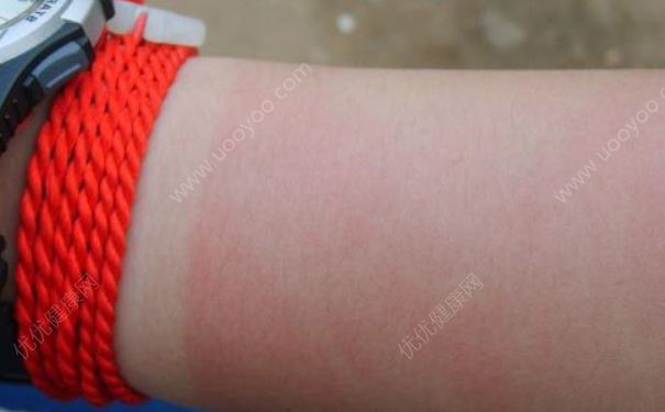 太阳晒后皮肤红怎么办？太阳晒伤皮肤怎么办？[多图]