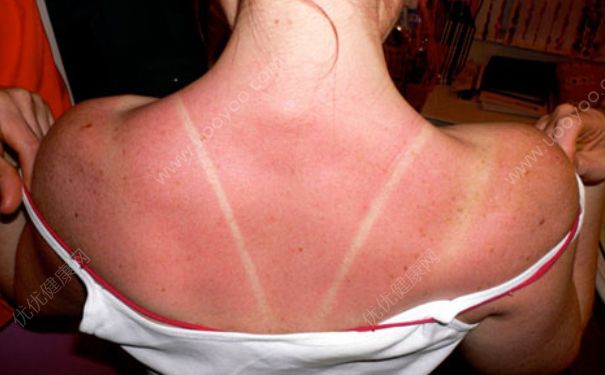 太阳晒后皮肤红怎么办？太阳晒伤皮肤怎么办？(2)