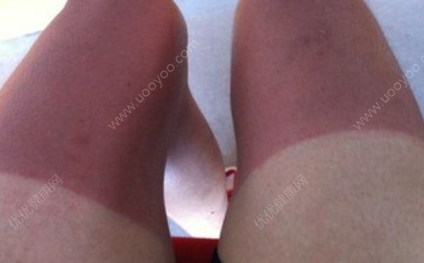 太阳晒后皮肤红怎么办？太阳晒伤皮肤怎么办？(4)