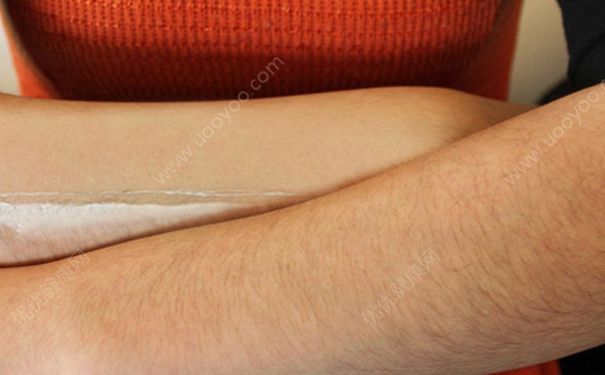 16岁女生能用脱毛膏吗？16岁女生汗毛重怎么办？(1)