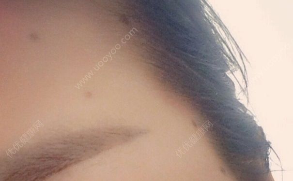 点痣可以喝可乐吗？点痣后可以喝碳酸饮料吗？(4)