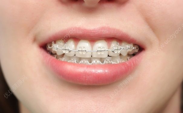 高中可以矫正牙齿吗？高中毕业可以做牙齿矫正吗？(3)
