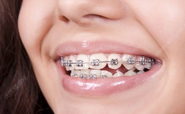高中可以矫正牙齿吗？高中毕业可以做牙齿矫正吗？(1)