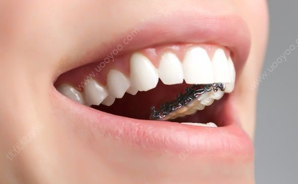 高中可以矫正牙齿吗？高中毕业可以做牙齿矫正吗？(2)