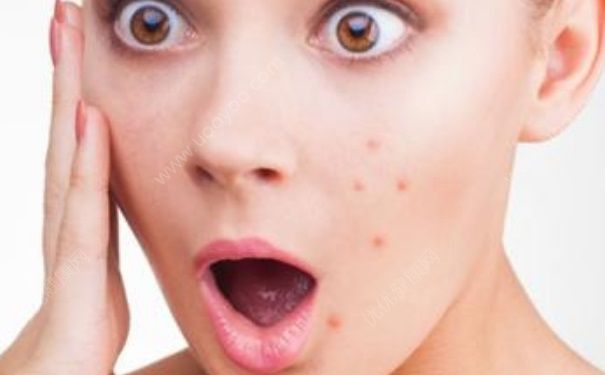 夏天容易长痘怎么办？夏天怎样防止长痘？(1)